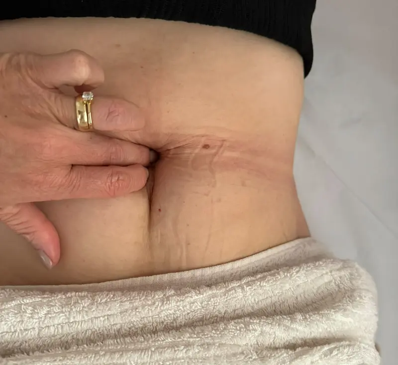 Fisioterapeuta medindo a diástase com os dedos na altura do umbigo